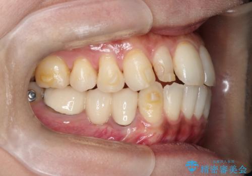 矮小歯を伴う叢生を審美的に改善|インビザライン矯正+セラミッククラウン修復の治療中