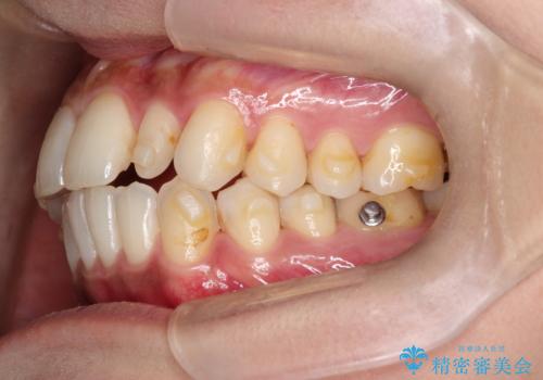 矮小歯を伴う叢生を審美的に改善|インビザライン矯正+セラミッククラウン修復の治療中