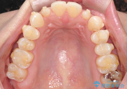 矮小歯を伴う叢生を審美的に改善|インビザライン矯正+セラミッククラウン修復の治療中