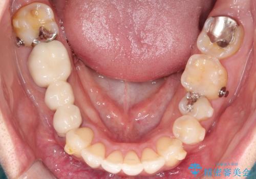 矮小歯を伴う叢生を審美的に改善|インビザライン矯正+セラミッククラウン修復の治療中