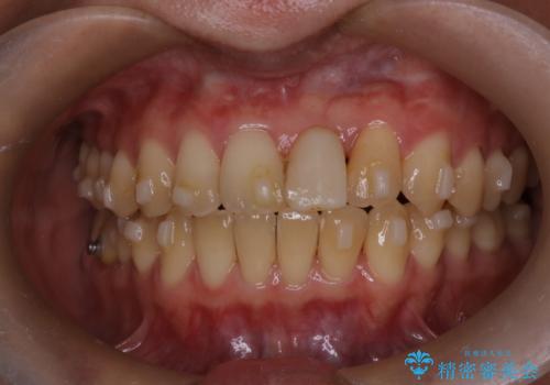 前歯の開咬とシザーズバイトを改善|インビザライン矯正の治療中