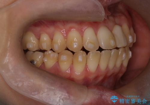 前歯の開咬とシザーズバイトを改善|インビザライン矯正の治療中