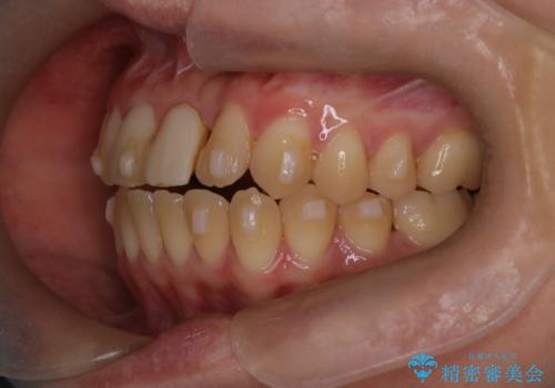 前歯の開咬とシザーズバイトを改善|インビザライン矯正の治療中