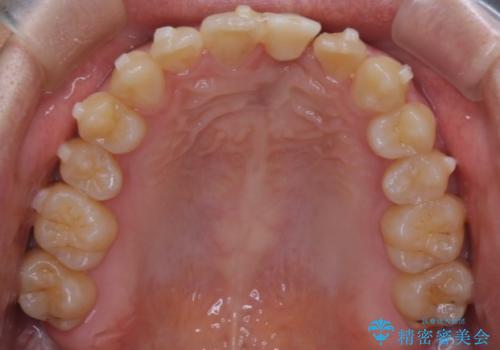 前歯の開咬とシザーズバイトを改善|インビザライン矯正の治療中