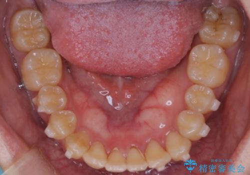 前歯の開咬とシザーズバイトを改善|インビザライン矯正の治療中