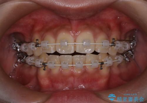 前歯の前突と口元の突出感を改善|上下左右4番抜歯+審美ワイヤー矯正の治療中
