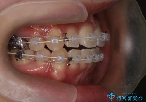 前歯の前突と口元の突出感を改善|上下左右4番抜歯+審美ワイヤー矯正の治療中