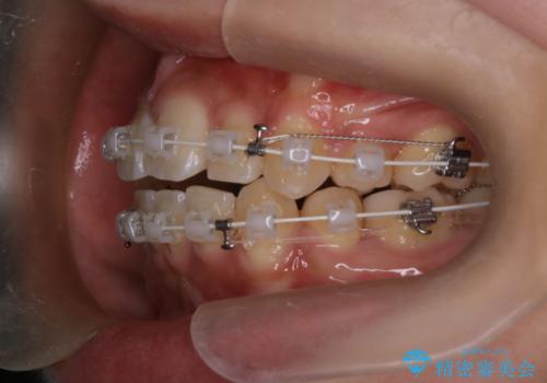 前歯の前突と口元の突出感を改善|上下左右4番抜歯+審美ワイヤー矯正の治療中
