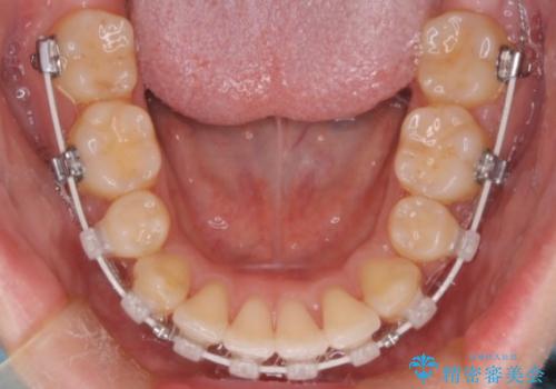 前歯の前突と口元の突出感を改善|上下左右4番抜歯+審美ワイヤー矯正の治療中