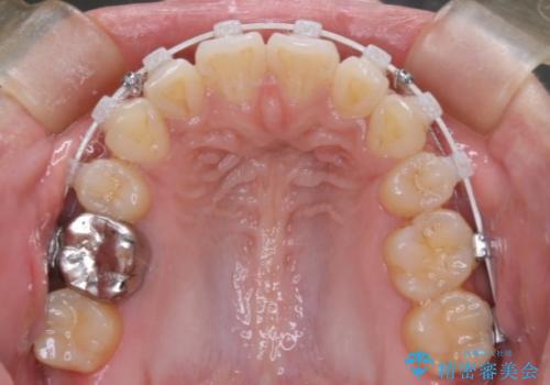 前歯の前突と口元の突出感を改善|上下左右4番抜歯+審美ワイヤー矯正の治療中
