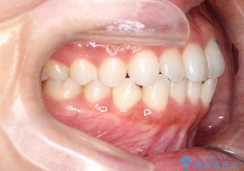 前歯の叢生を非抜歯で改善|インビザライン+IPR・遠心移動・FIX保定の治療前