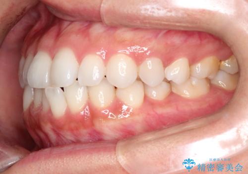 前歯の叢生を非抜歯で改善|インビザライン+IPR・遠心移動・FIX保定の治療前