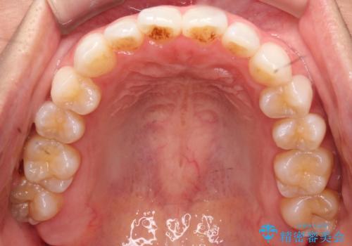 前歯の叢生を非抜歯で改善|インビザライン+IPR・遠心移動・FIX保定の治療前