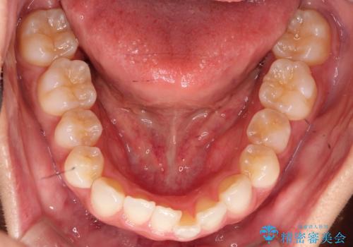 前歯の叢生を非抜歯で改善|インビザライン+IPR・遠心移動・FIX保定の治療前