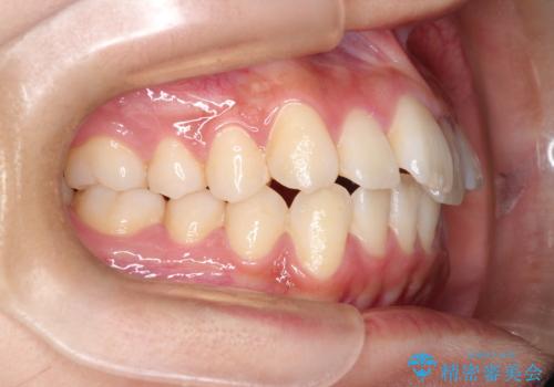 前歯の叢生・Ⅱ級咬合を改善|TADを用いた遠心移動+インビザライン矯正の治療前