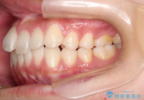 前歯の叢生・Ⅱ級咬合を改善|TADを用いた遠心移動+インビザライン矯正の治療前