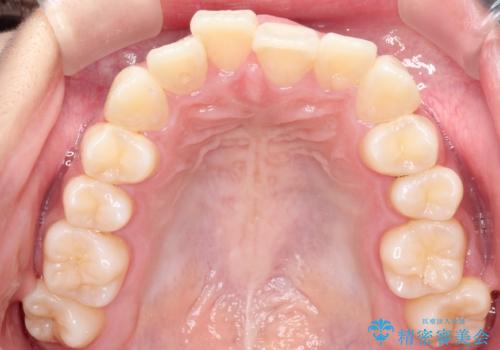 前歯の叢生・Ⅱ級咬合を改善|TADを用いた遠心移動+インビザライン矯正の治療前
