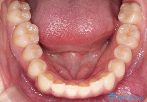 前歯の叢生・Ⅱ級咬合を改善|TADを用いた遠心移動+インビザライン矯正の治療前