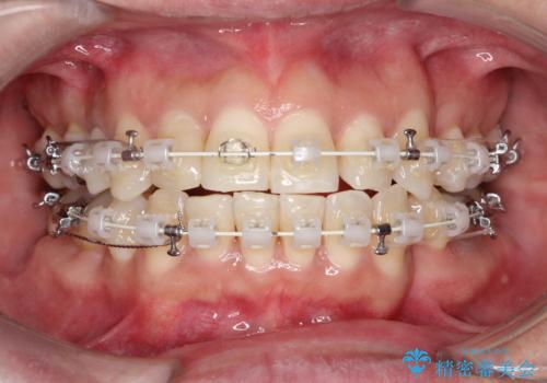 重度の叢生を抜歯矯正で改善|審美ワイヤー矯正+海外出張に伴う中断・再開対応の治療中