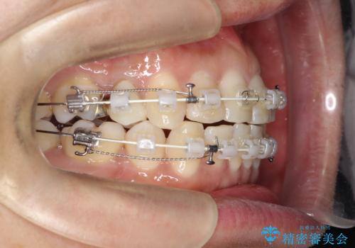 重度の叢生を抜歯矯正で改善|審美ワイヤー矯正+海外出張に伴う中断・再開対応の治療中