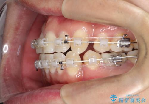重度の叢生を抜歯矯正で改善|審美ワイヤー矯正+海外出張に伴う中断・再開対応の治療中