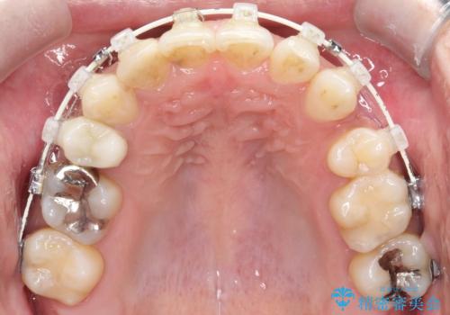 重度の叢生を抜歯矯正で改善|審美ワイヤー矯正+海外出張に伴う中断・再開対応の治療中