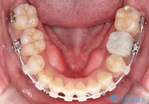 重度の叢生を抜歯矯正で改善|審美ワイヤー矯正+海外出張に伴う中断・再開対応の治療中