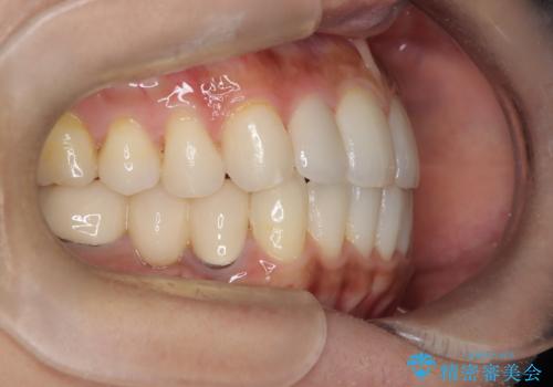 矮小歯を伴う叢生を審美的に改善|インビザライン矯正+セラミッククラウン修復の治療後