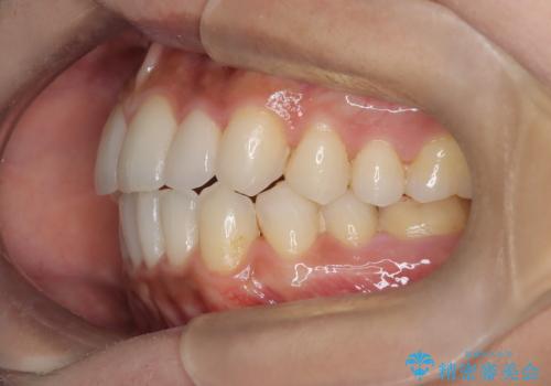 矮小歯を伴う叢生を審美的に改善|インビザライン矯正+セラミッククラウン修復の治療後