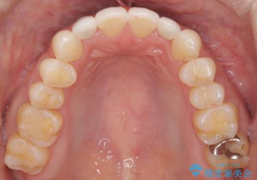 矮小歯を伴う叢生を審美的に改善|インビザライン矯正+セラミッククラウン修復の治療後