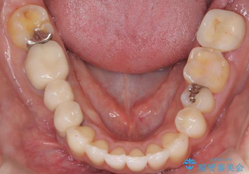 矮小歯を伴う叢生を審美的に改善|インビザライン矯正+セラミッククラウン修復の治療後