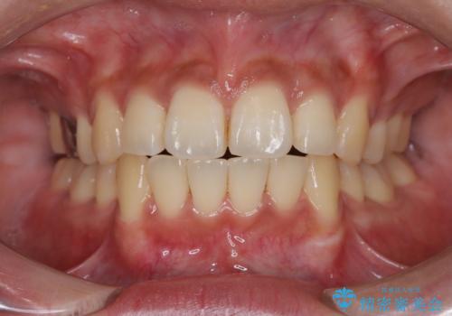 前歯の前突と口元の突出感を改善|上下左右4番抜歯+審美ワイヤー矯正の治療後