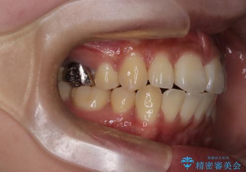 前歯の前突と口元の突出感を改善|上下左右4番抜歯+審美ワイヤー矯正の治療後