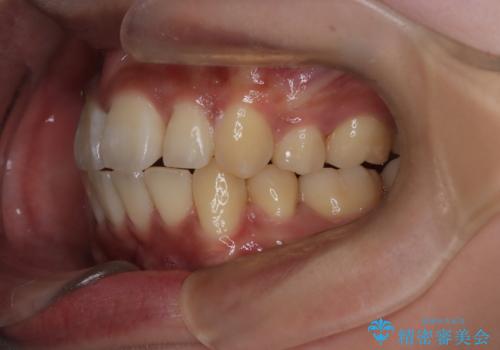 前歯の前突と口元の突出感を改善|上下左右4番抜歯+審美ワイヤー矯正の治療後