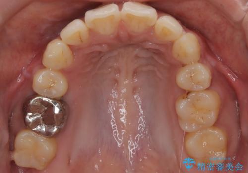 前歯の前突と口元の突出感を改善|上下左右4番抜歯+審美ワイヤー矯正の治療後