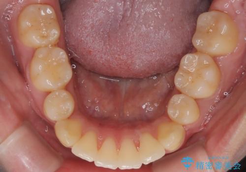 前歯の前突と口元の突出感を改善|上下左右4番抜歯+審美ワイヤー矯正の治療後