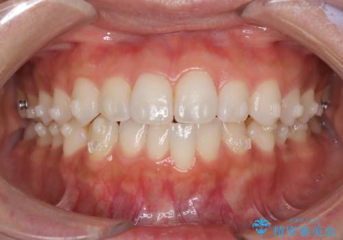 前歯の叢生を非抜歯で改善|インビザライン+IPR・遠心移動・FIX保定の治療中