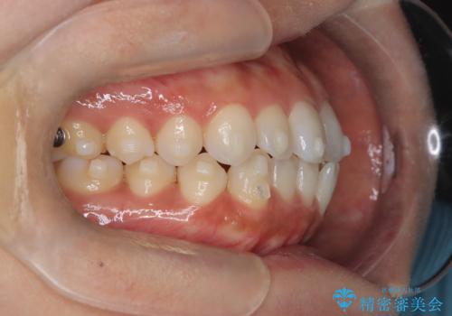 前歯の叢生を非抜歯で改善|インビザライン+IPR・遠心移動・FIX保定の治療中