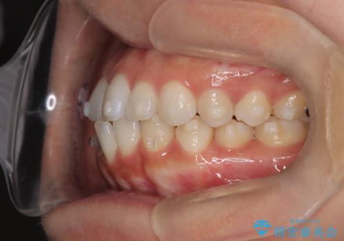 前歯の叢生を非抜歯で改善|インビザライン+IPR・遠心移動・FIX保定の治療中