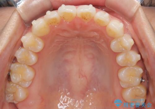 前歯の叢生を非抜歯で改善|インビザライン+IPR・遠心移動・FIX保定の治療中