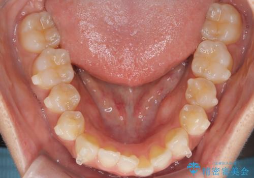 前歯の叢生を非抜歯で改善|インビザライン+IPR・遠心移動・FIX保定の治療中