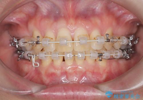 抜歯を伴う審美ワイヤー矯正の治療中