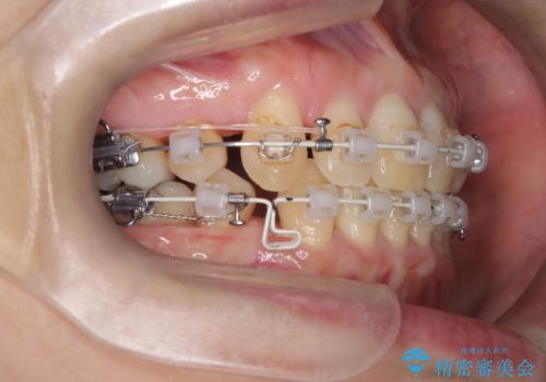 抜歯を伴う審美ワイヤー矯正の治療中