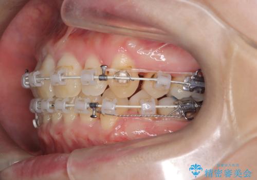 抜歯を伴う審美ワイヤー矯正の治療中