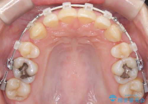 抜歯を伴う審美ワイヤー矯正の治療中