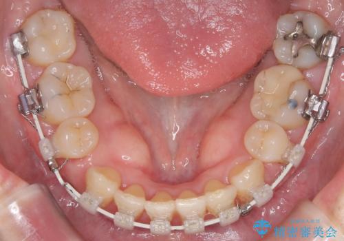 抜歯を伴う審美ワイヤー矯正の治療中