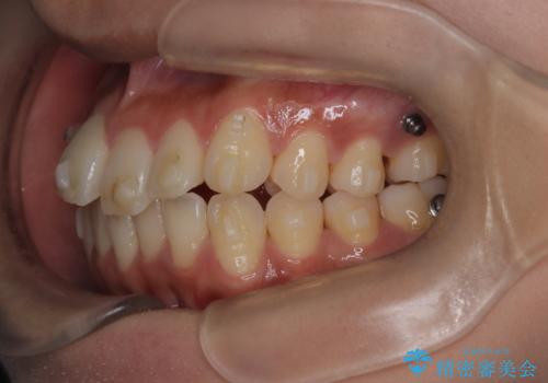 前歯の叢生・Ⅱ級咬合を改善|TADを用いた遠心移動+インビザライン矯正の治療中