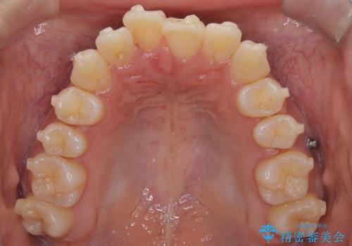 前歯の叢生・Ⅱ級咬合を改善|TADを用いた遠心移動+インビザライン矯正の治療中