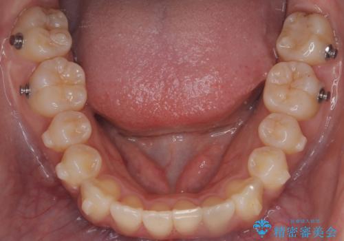 前歯の叢生・Ⅱ級咬合を改善|TADを用いた遠心移動+インビザライン矯正の治療中