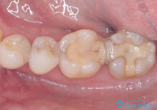 セラミックで叶える集中審美治療の症例 治療前